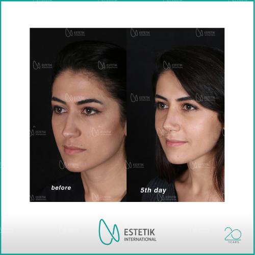 عملية تجميل الأنف صور قبل وبعد